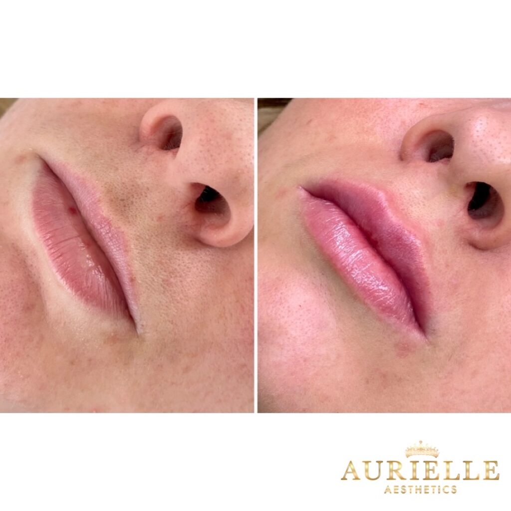 Why Lip Fillers Are Becoming a Must-Have Beauty Trend